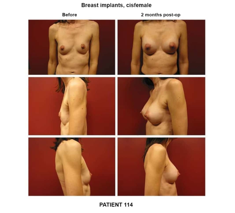 114_breast implants-cisfemale