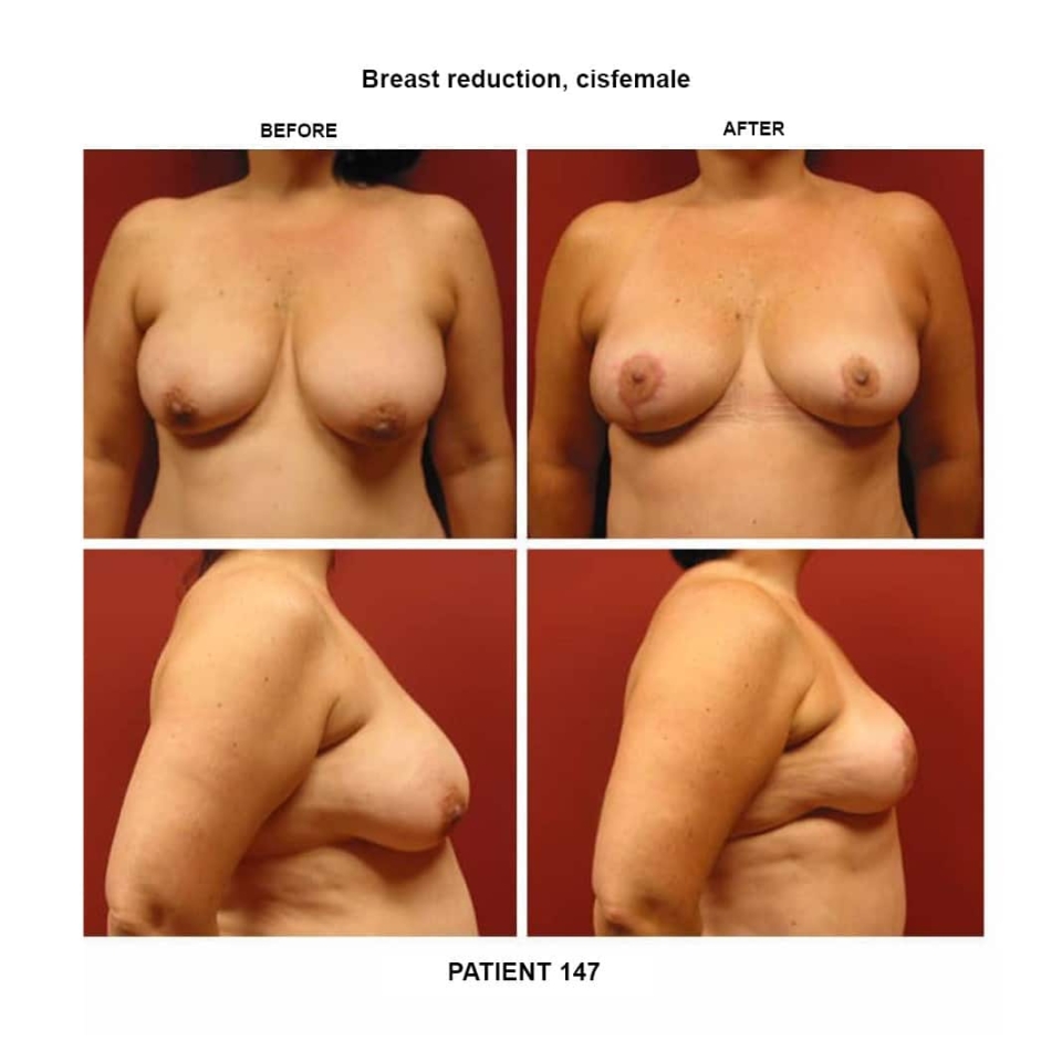 147_breast reduction-cisfemale