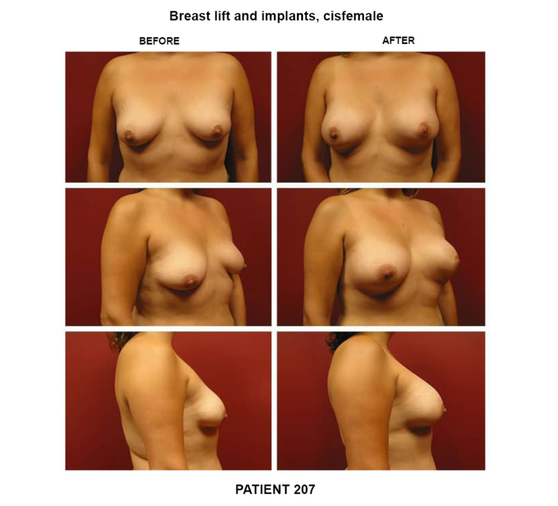 207_breast lift-implants-cisfemale