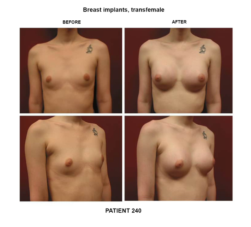 240_breast implants-transfemale