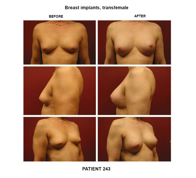243_breast implants-transfemale