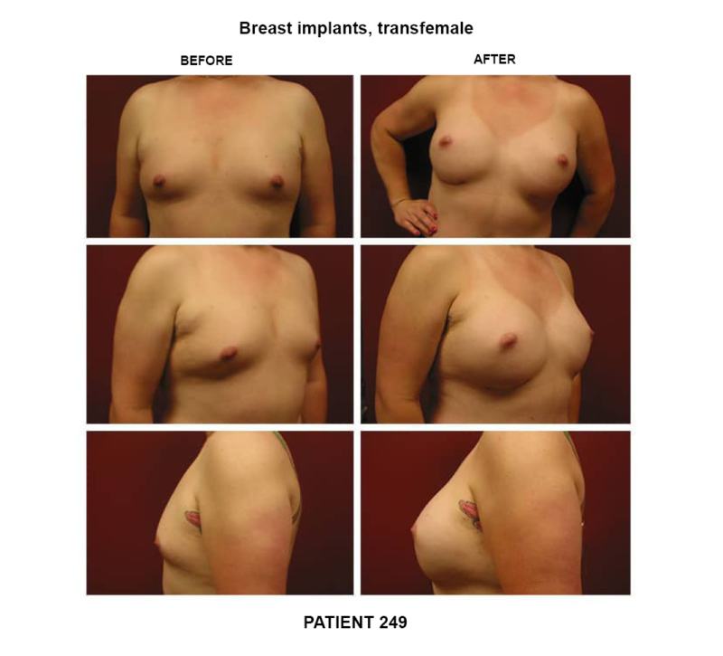 249_breast implants-transfemale