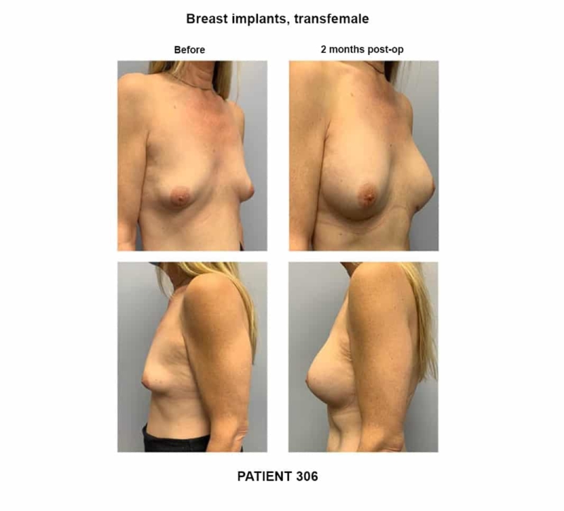 306_breast implants-transfemale
