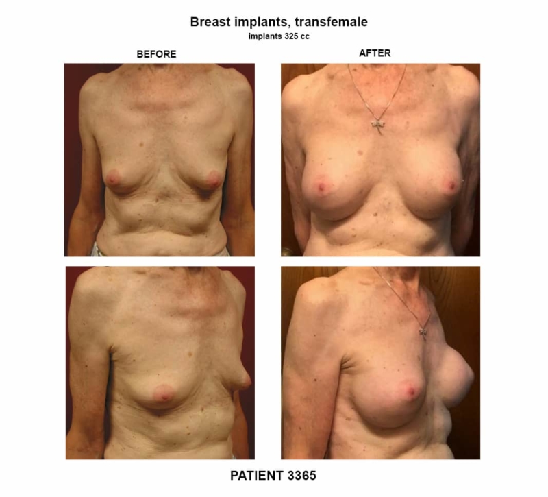 3365_breast implants-transfemale
