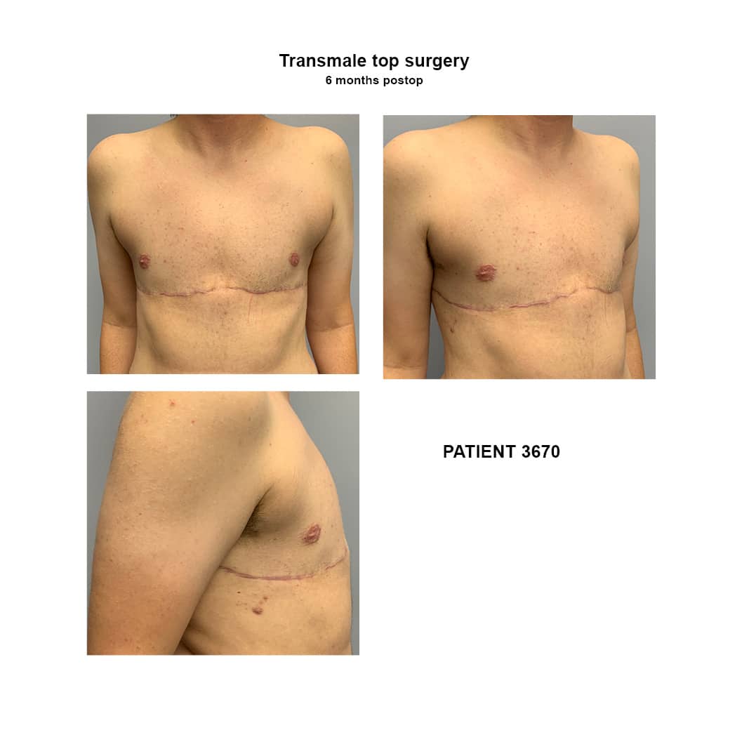3670_transmale top surgery
