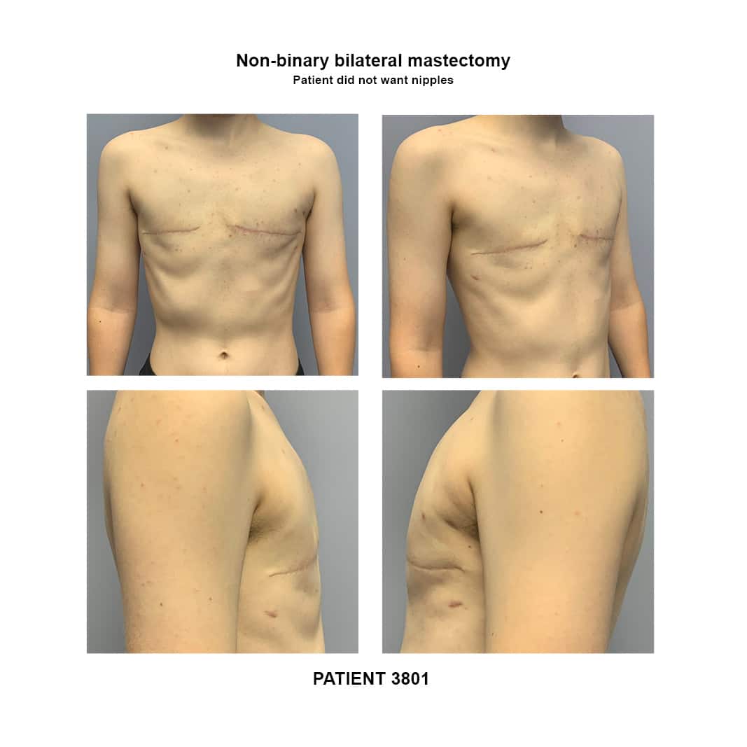 3801_Non-binary bilateral mastectomy