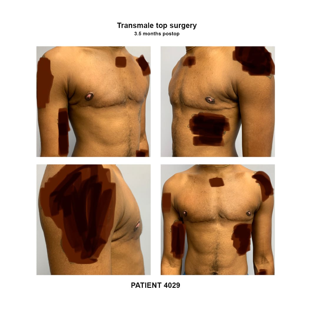 4029_transmale top surgery