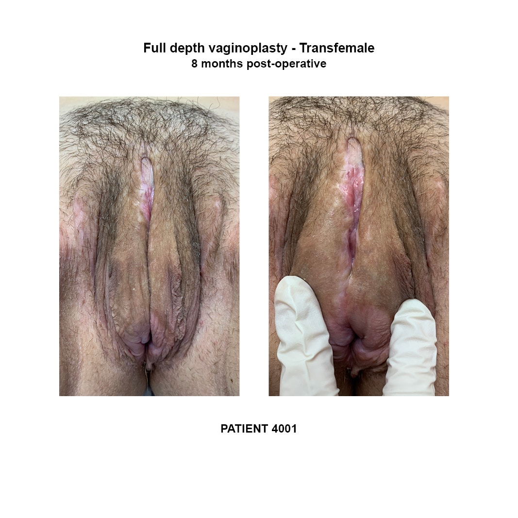 4001_transfemale full depth vaginoplasty