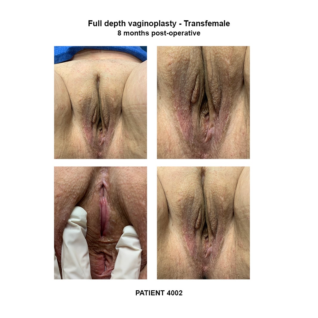 4002_transfemale full depth vaginoplasty