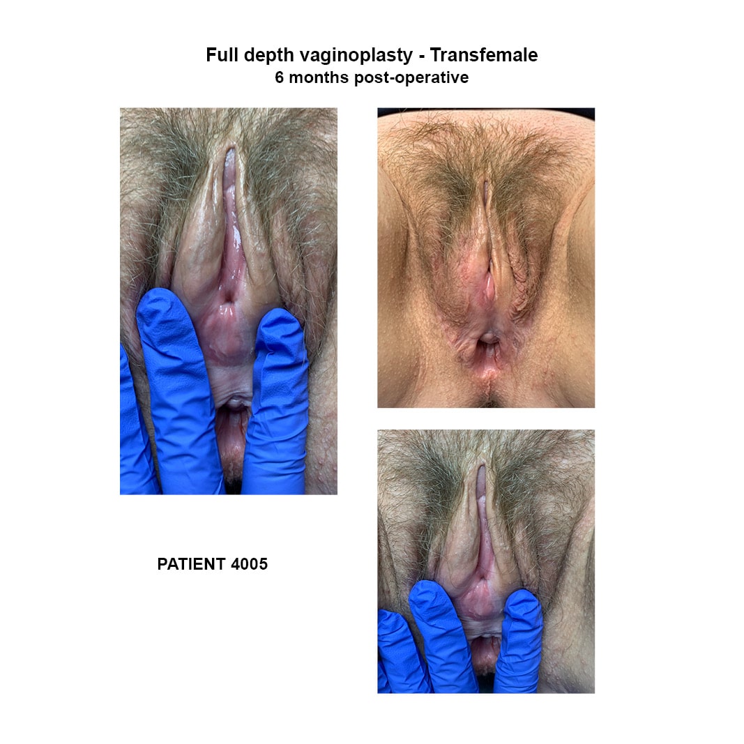4005_transfemale full depth vaginoplasty