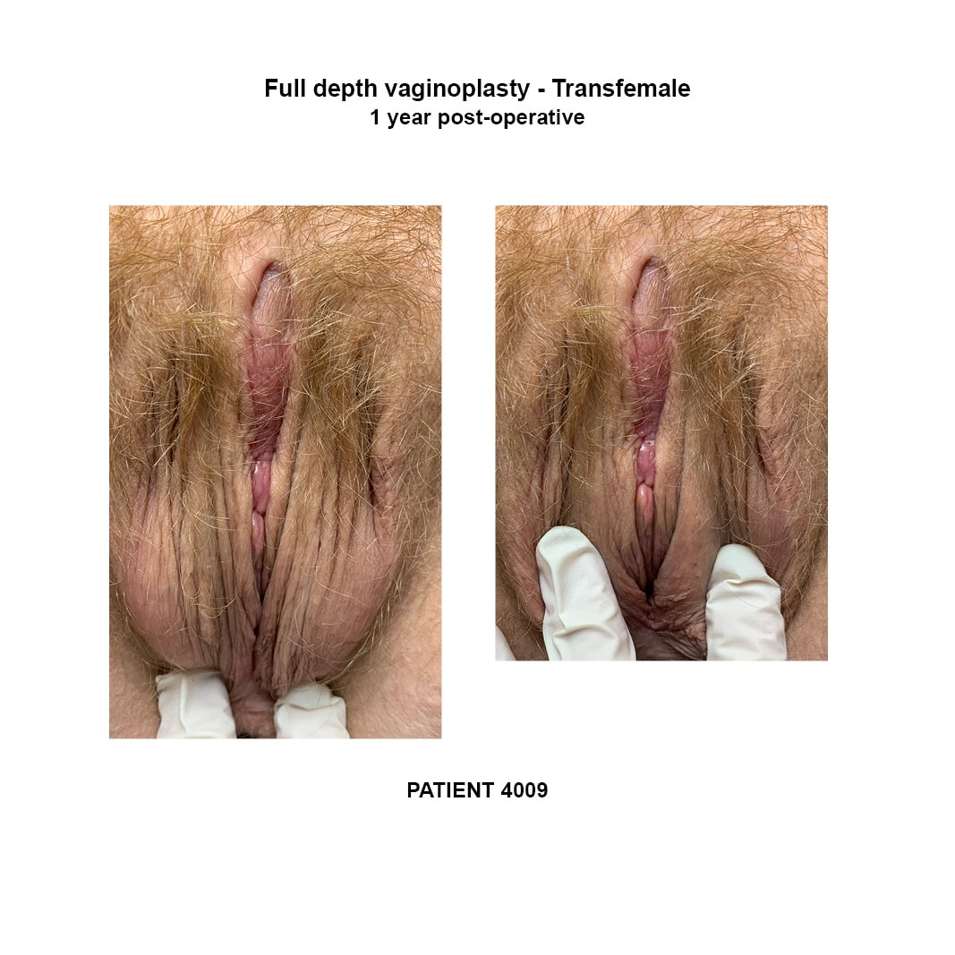 4009_transfemale full depth vaginoplasty