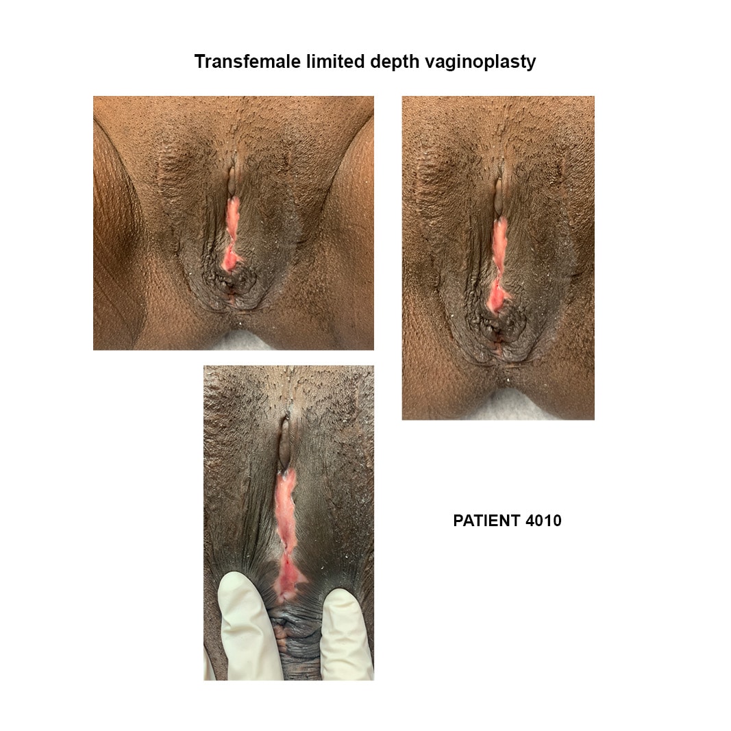 4010_transfemale limited depth vaginoplasty
