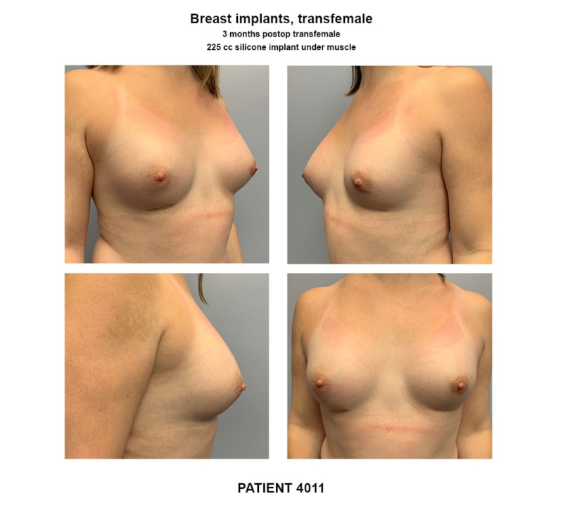 4011_breast implants-transfemale
