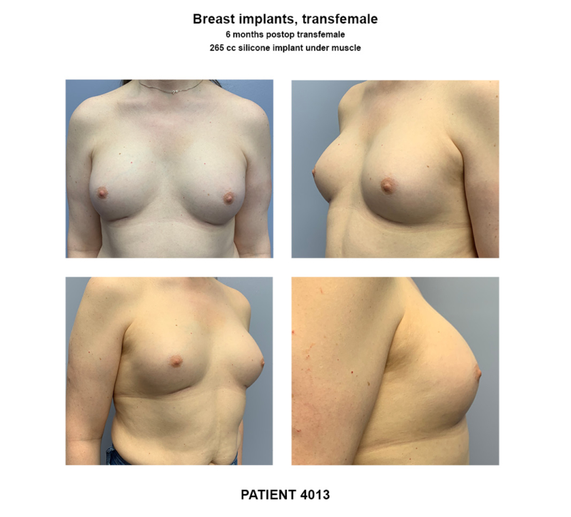 4013_breast implants-transfemale