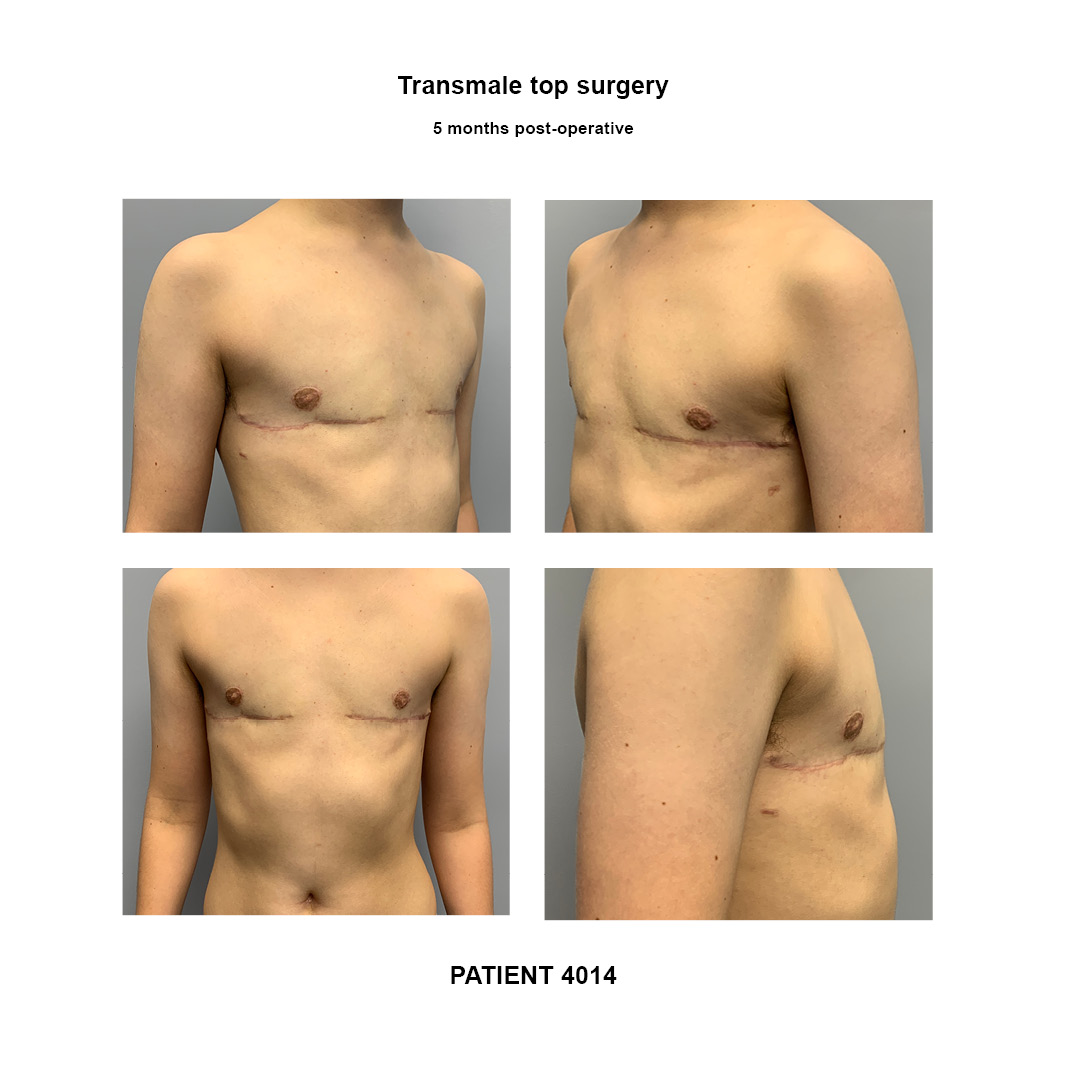 4014_top-surgery-transmale