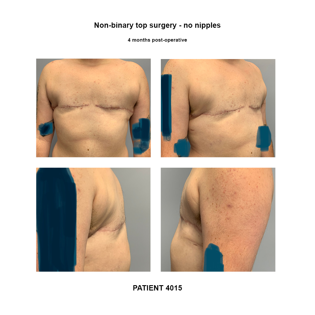 4015_non-binary-top-surgery-no-nipples