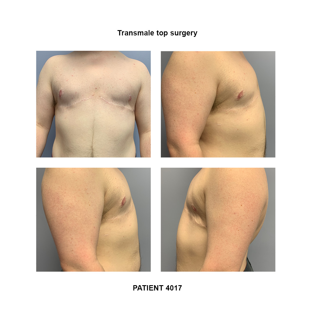 4017_transmale-top-surgery