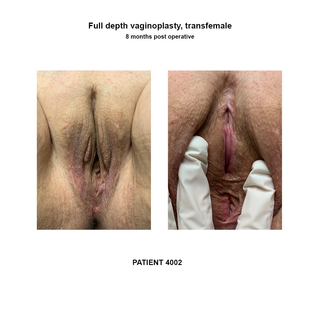 4002_full-depth-vaginoplasty_2photos