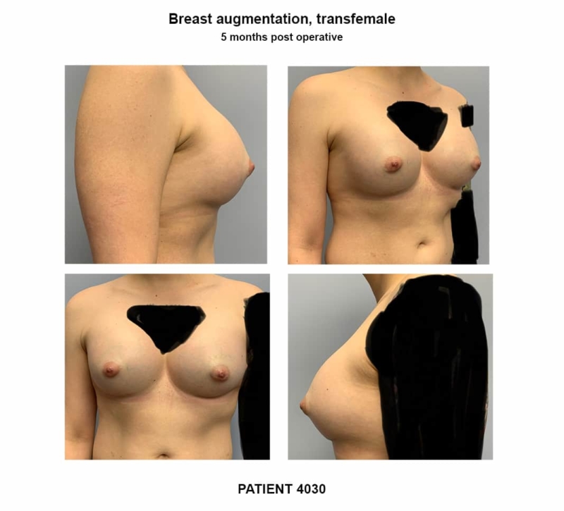 4030_breast implants-transfemale