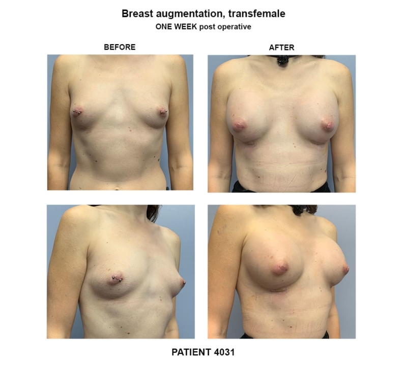 4031_breast implants-transfemale