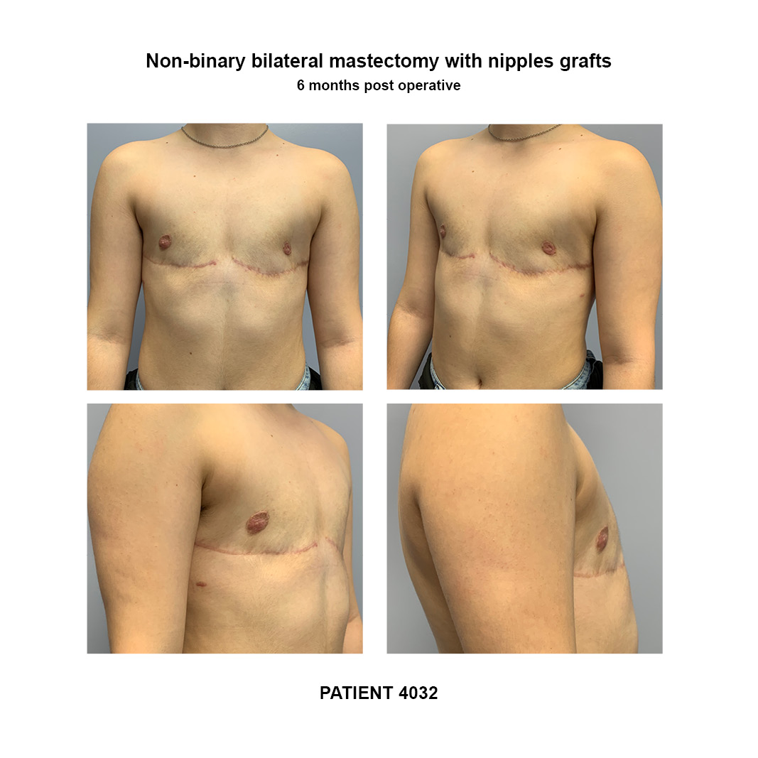 4032_non-binary-mastectomy