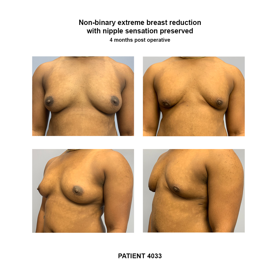 4033_non-binary-breast-reduction