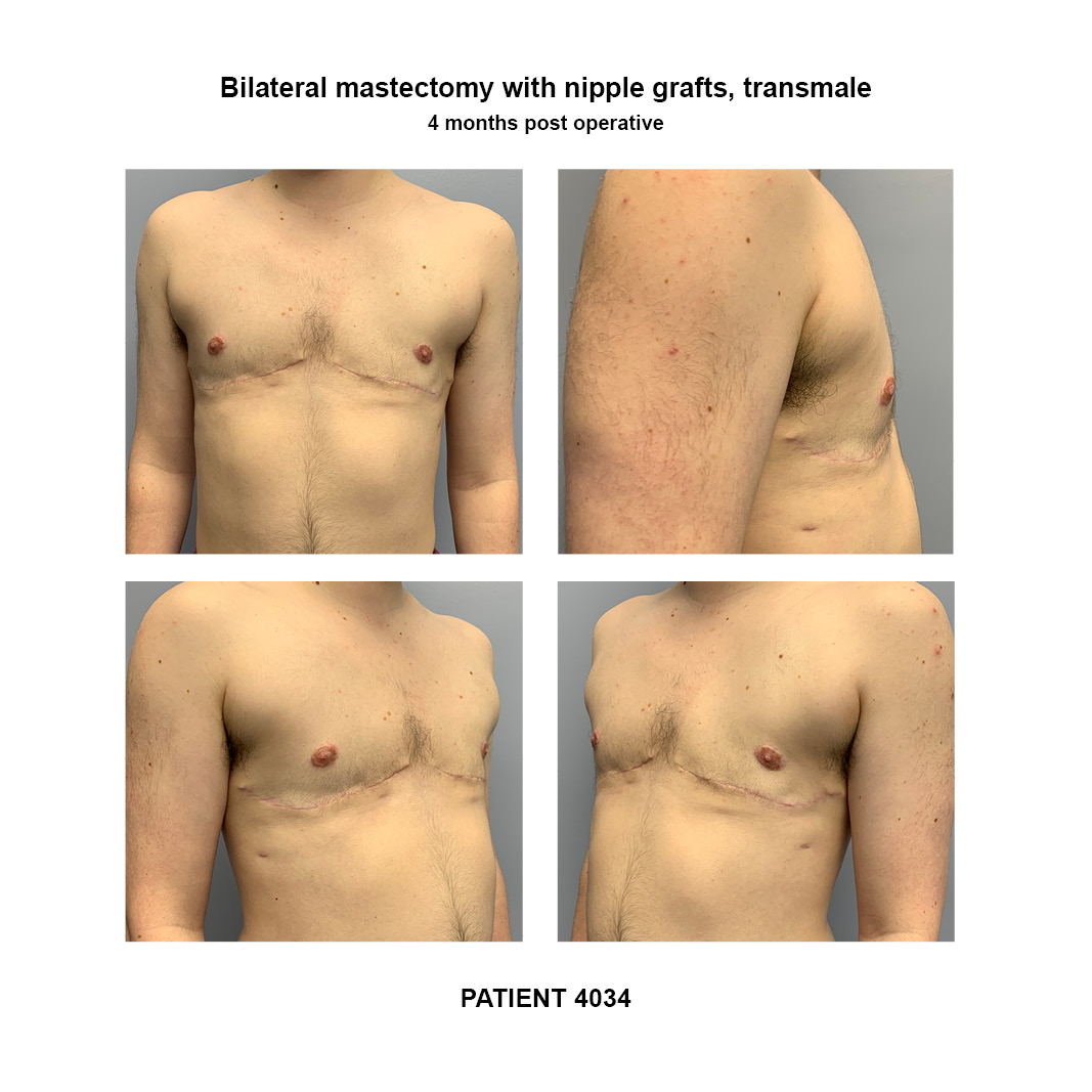 4034_bilateral-mastectomy-transmale