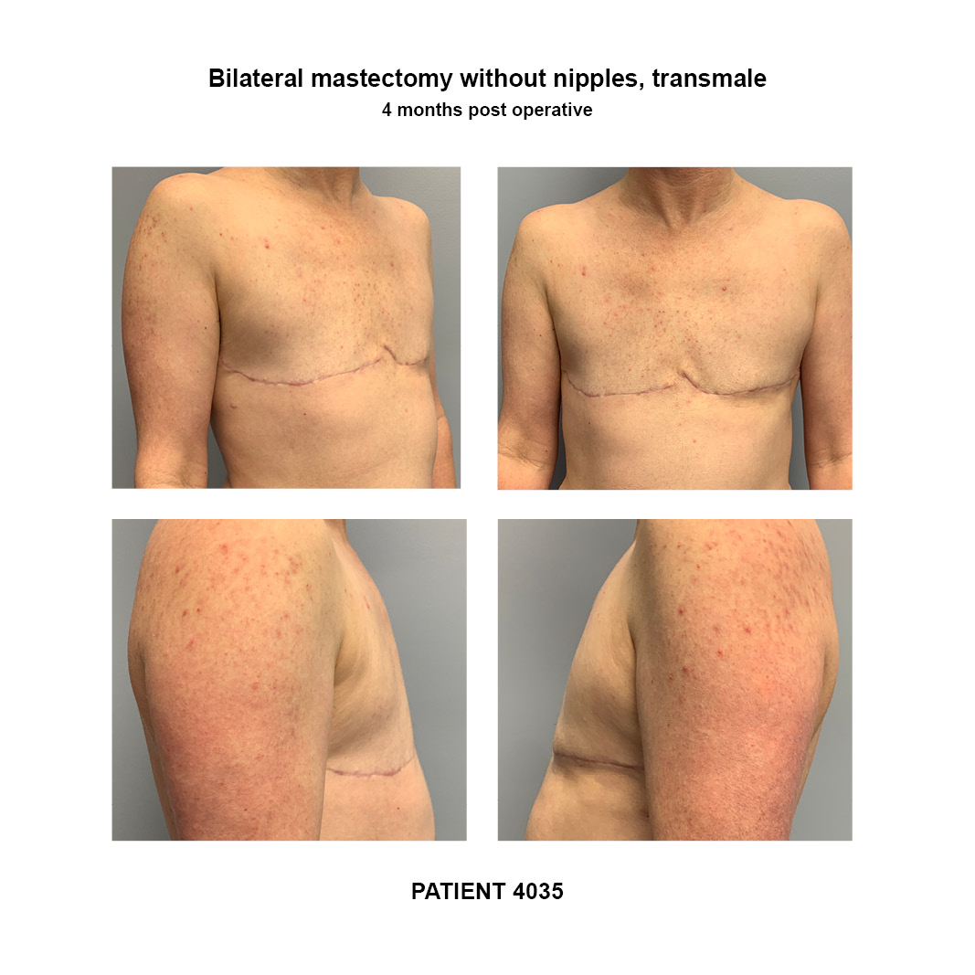4035_bilateral-mastectomy-transmale