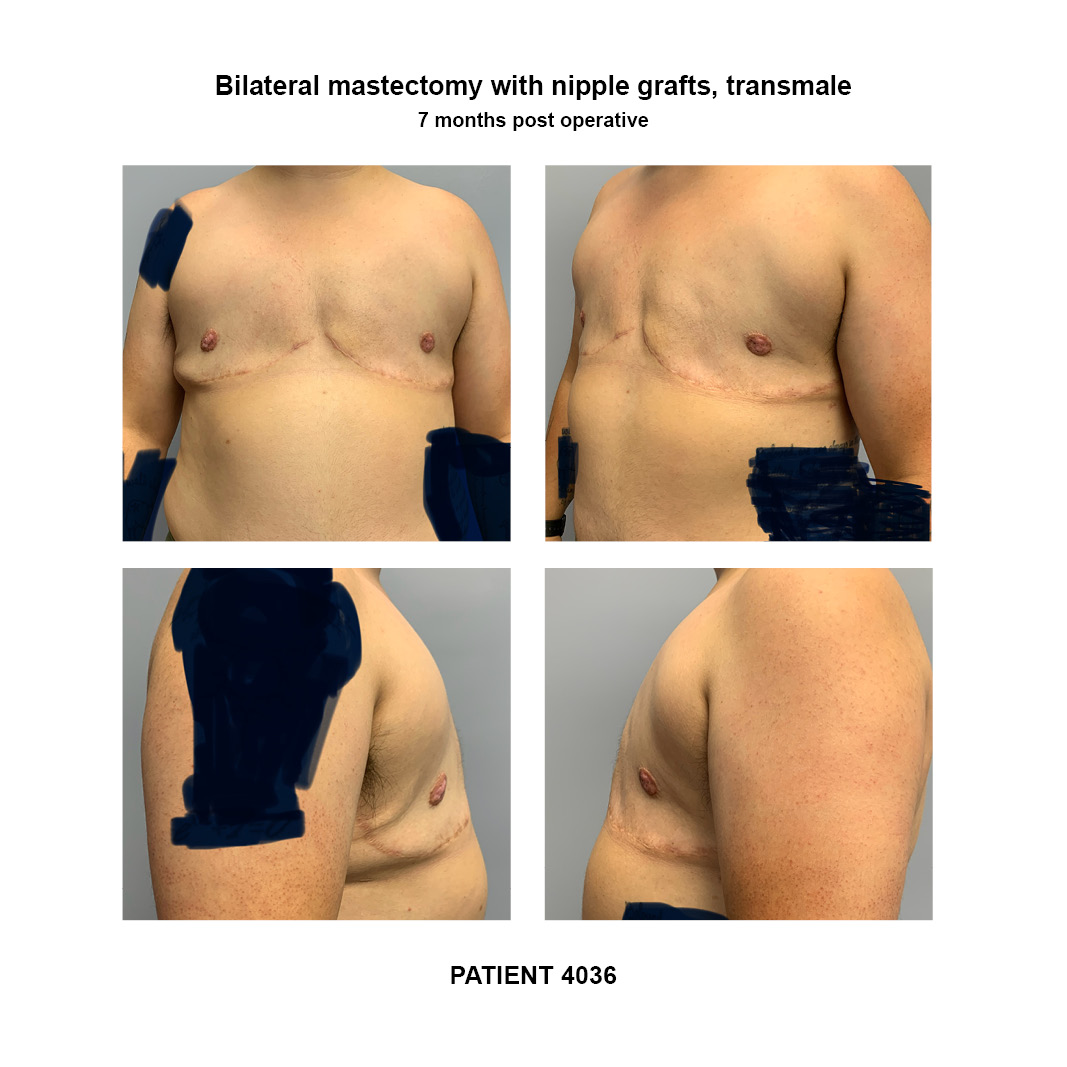 4036_bilateral-mastectomy-transmale
