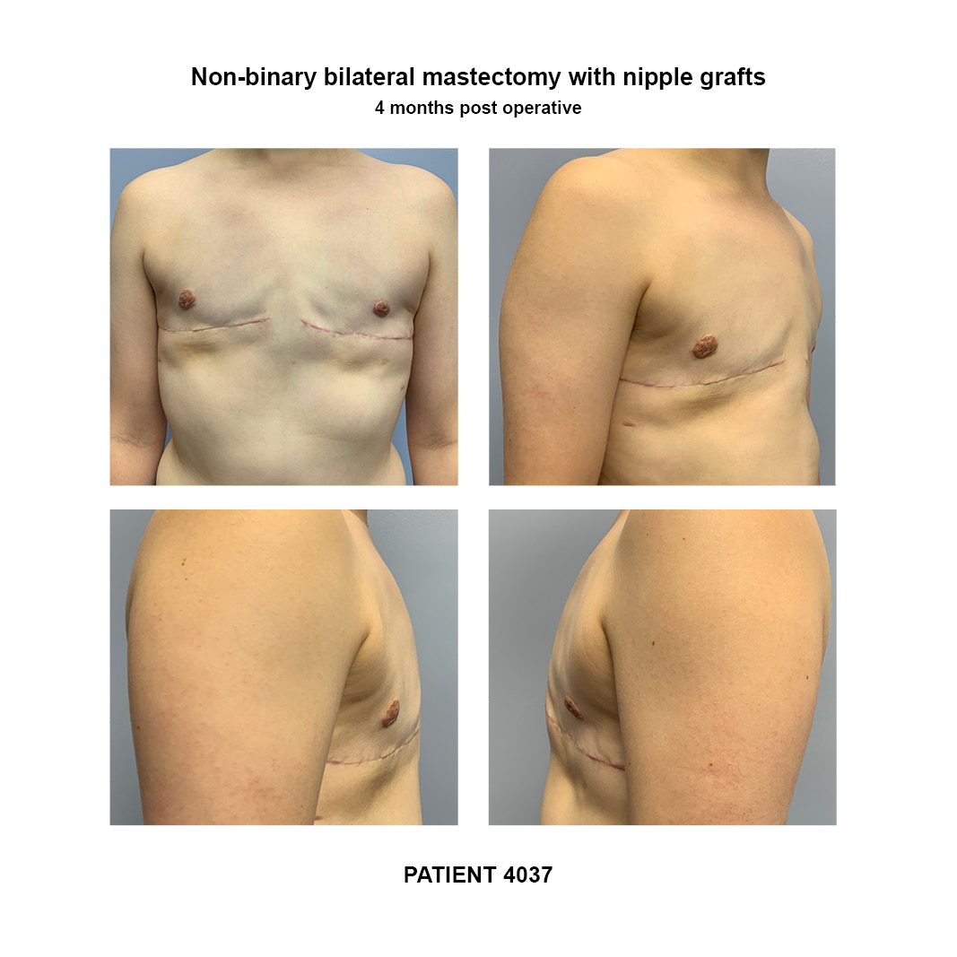 4037_non-binary-bilateral-mastectomy