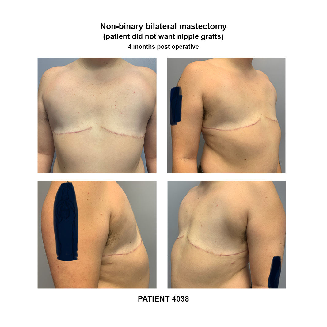 4038_non-binary-bilateral-mastectomy