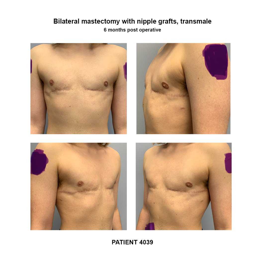 4039_bilateral-mastectomy-transmale
