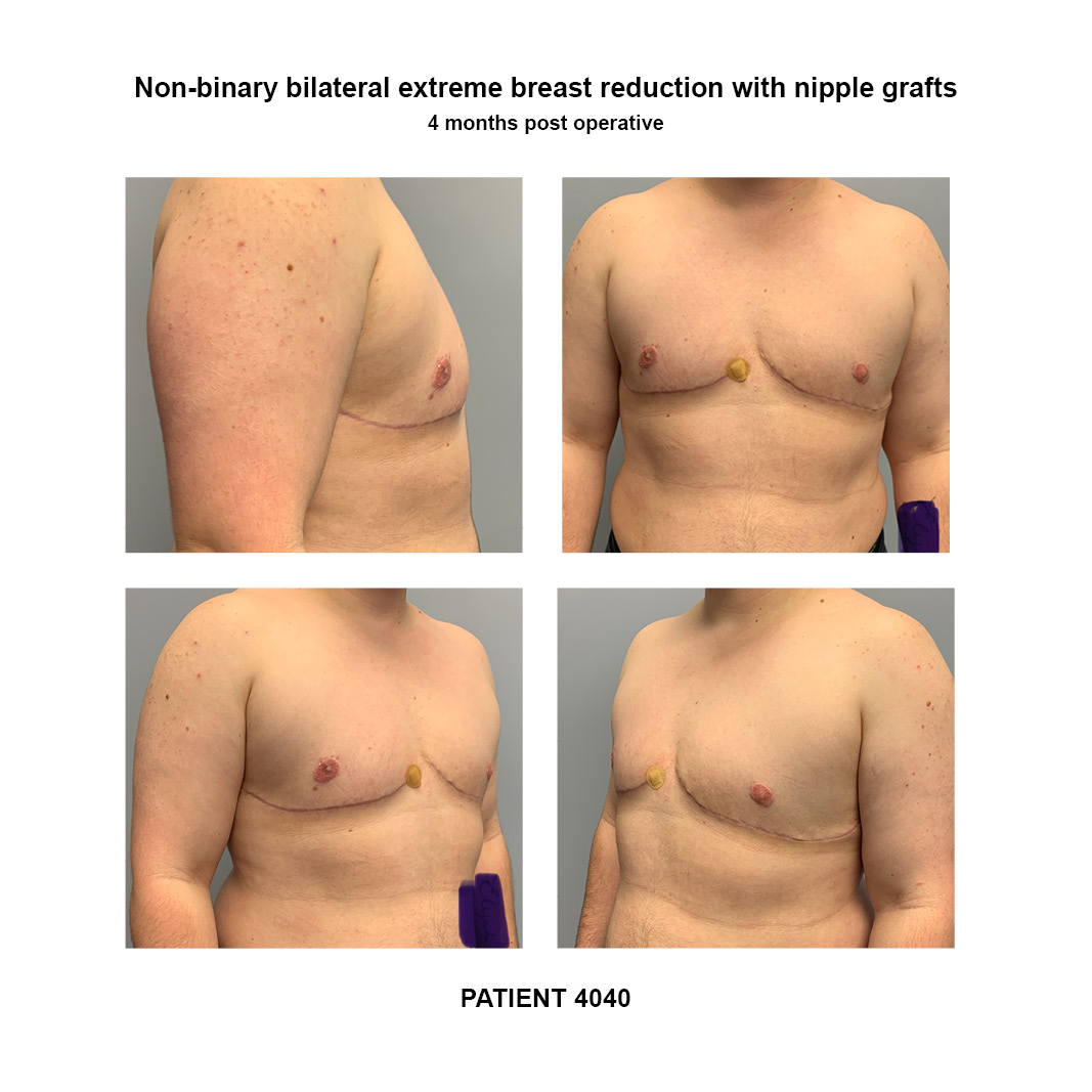 A Non-Binary Take on Breast Reduction