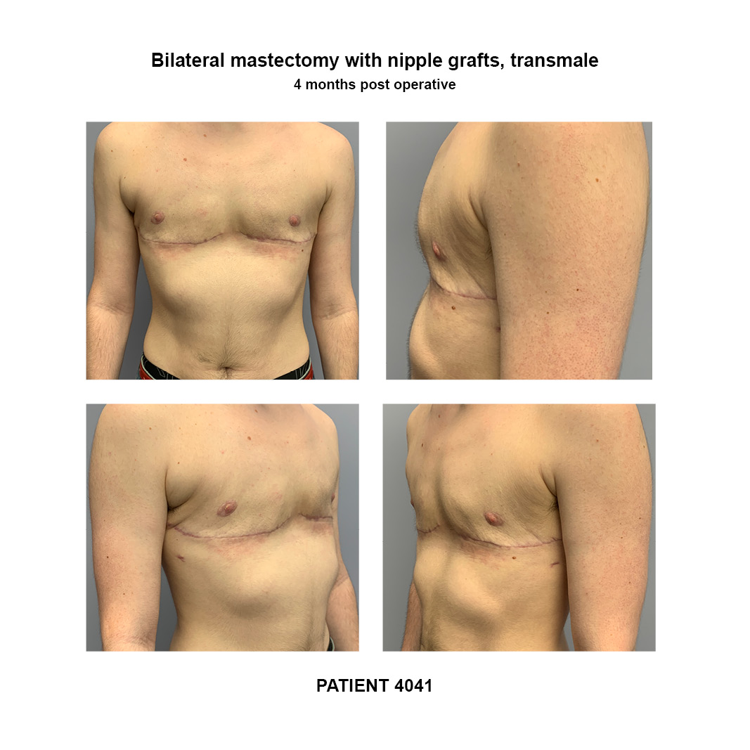 4041_bilateral-mastectomy-transmale