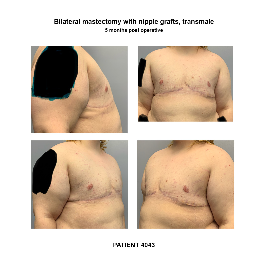 4043_bilateral-mastectomy-transmale