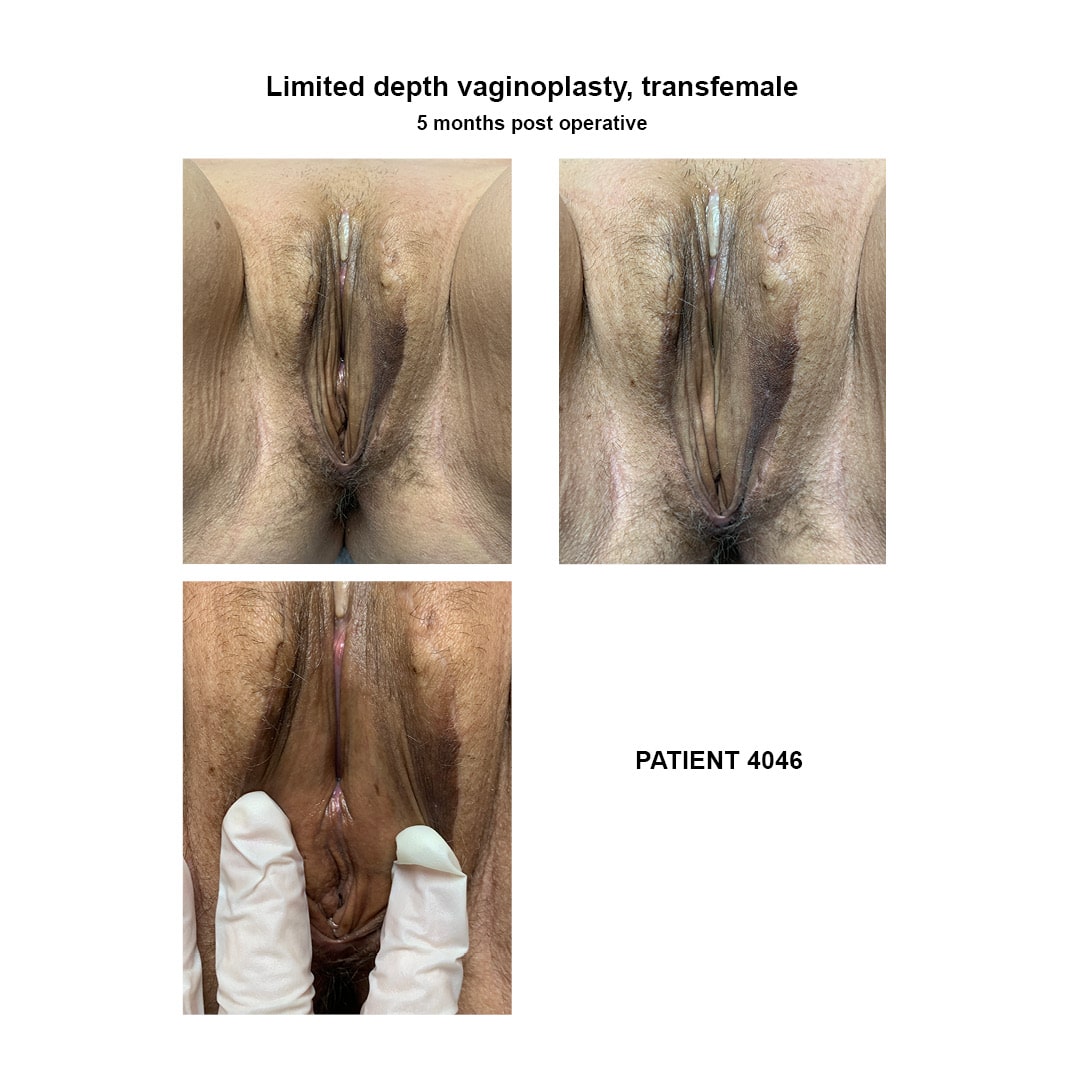 4046_limited-depth-vaginoplasty