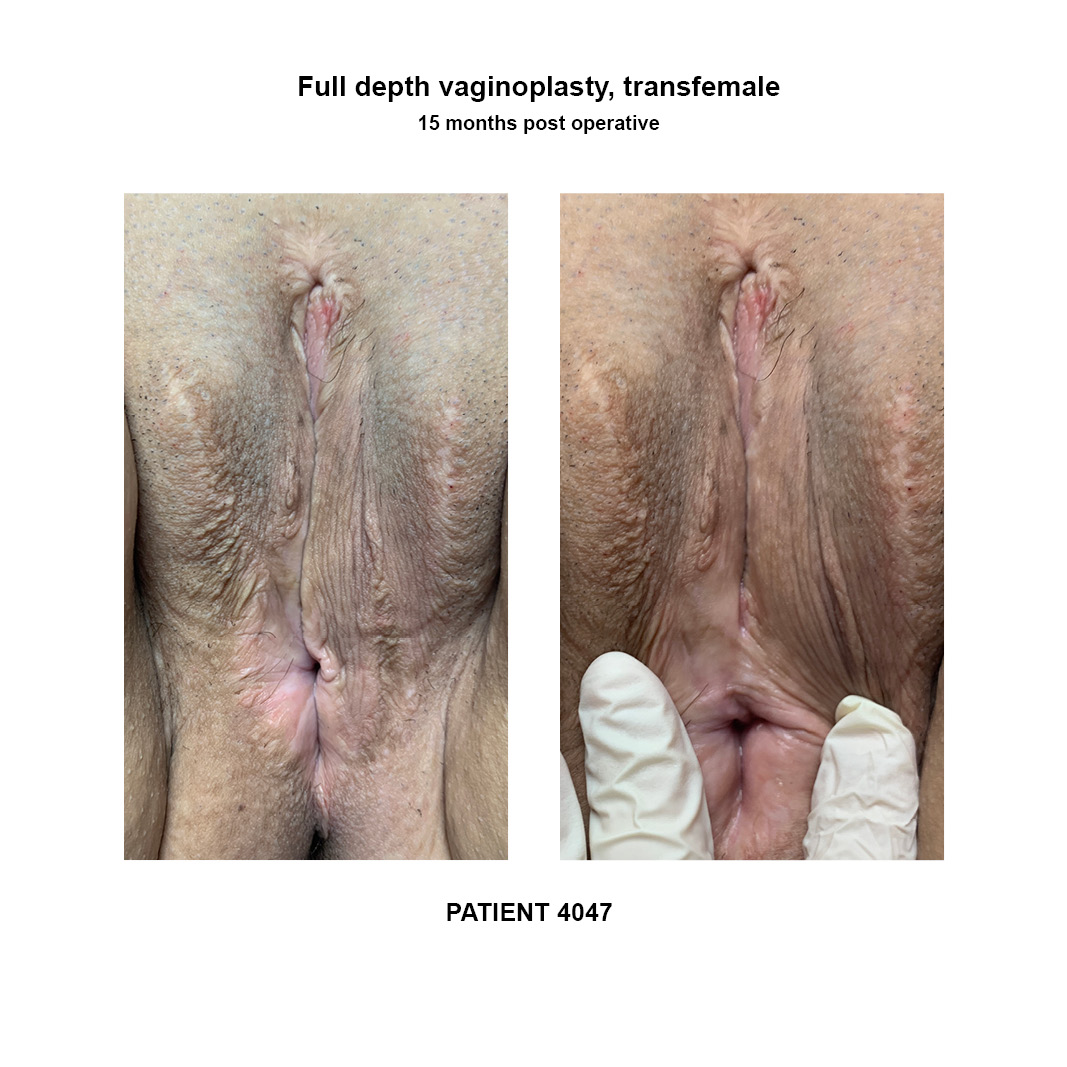 4047_full-depth-vaginoplasty
