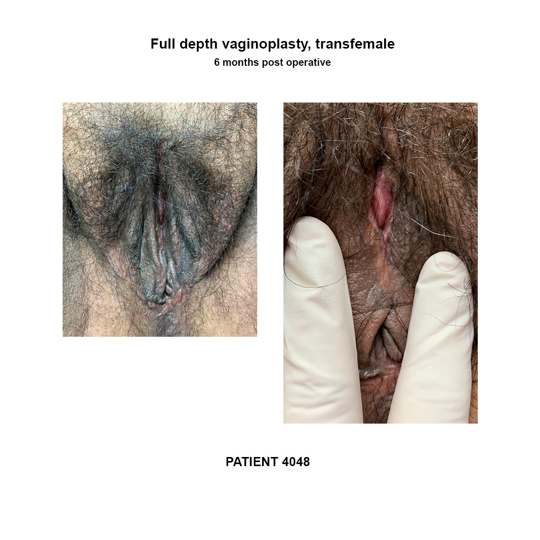 4048_full-depth-vaginoplasty