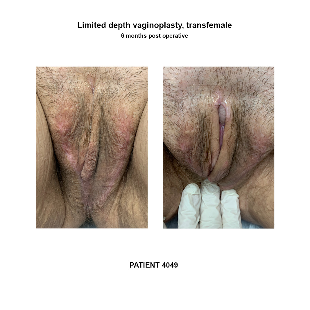 4049_limited-depth-vaginoplasty