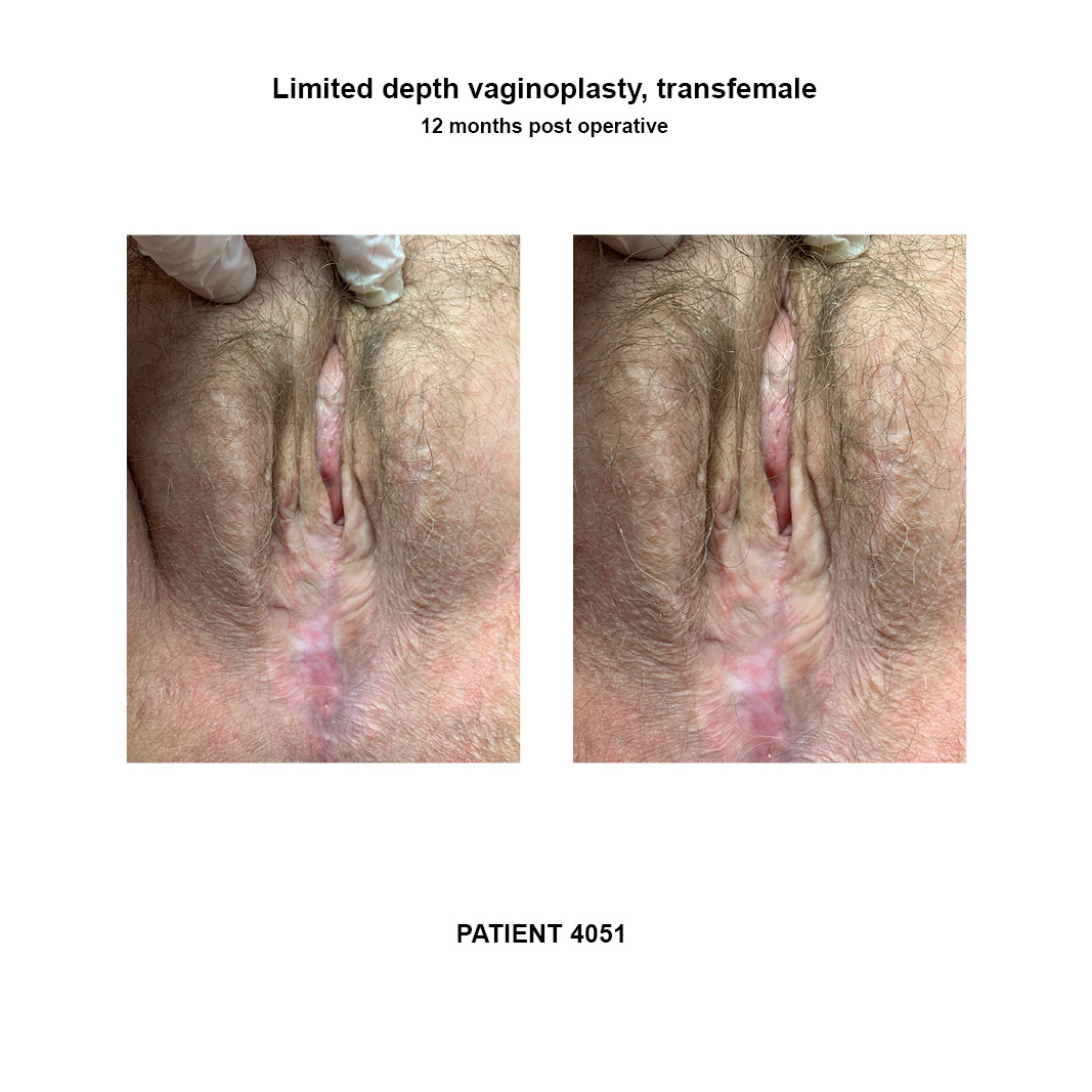 4051_limited-depth-vaginoplasty