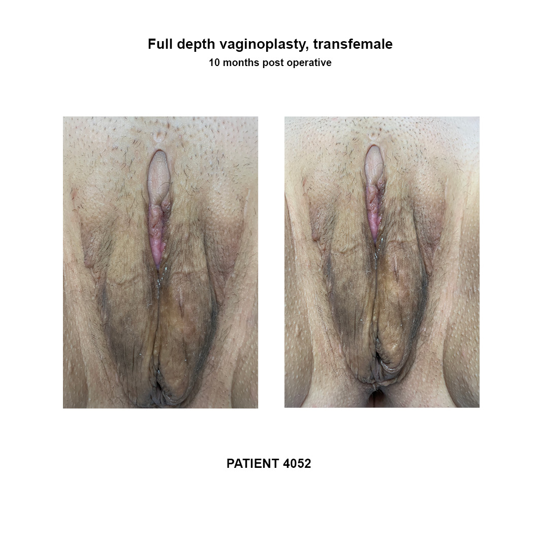 4052_full-depth-vaginoplasty