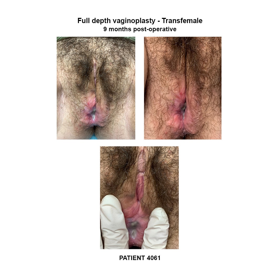 4061_transfemale full depth vaginoplasty