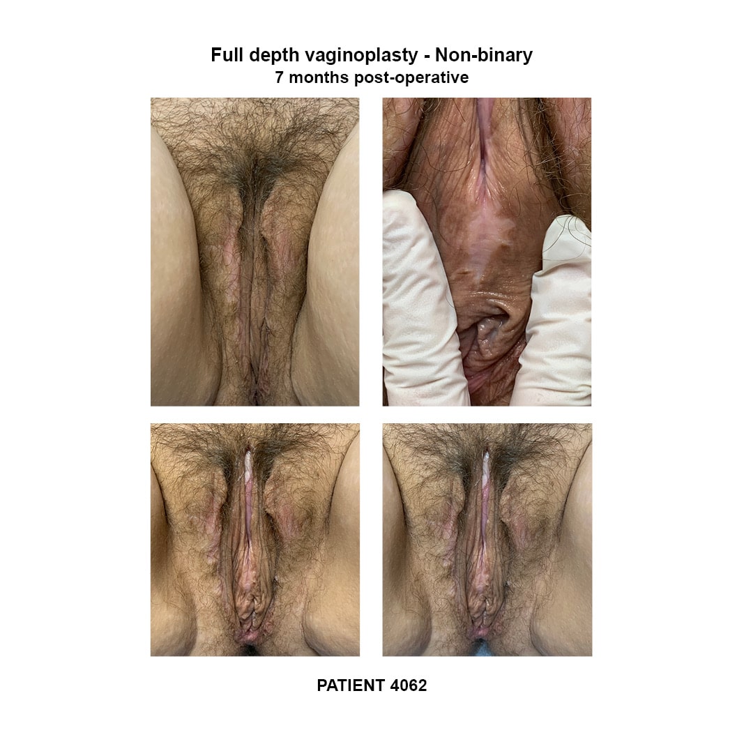 4062_non-binary full depth vaginoplasty