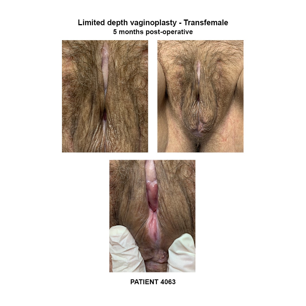 4063_transfemale limited depth vaginoplasty