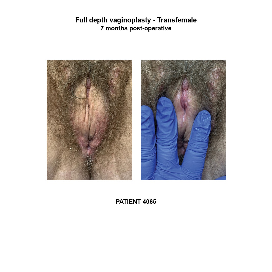 4065_transfemale full depth vaginoplasty