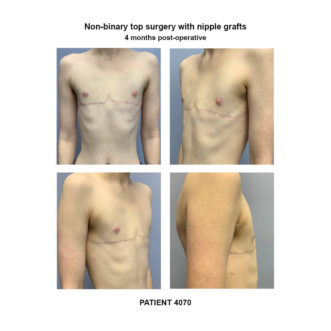 4070_non-binary-top-surgery-nipple-graft