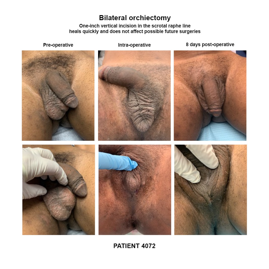 4072_orchiectomy