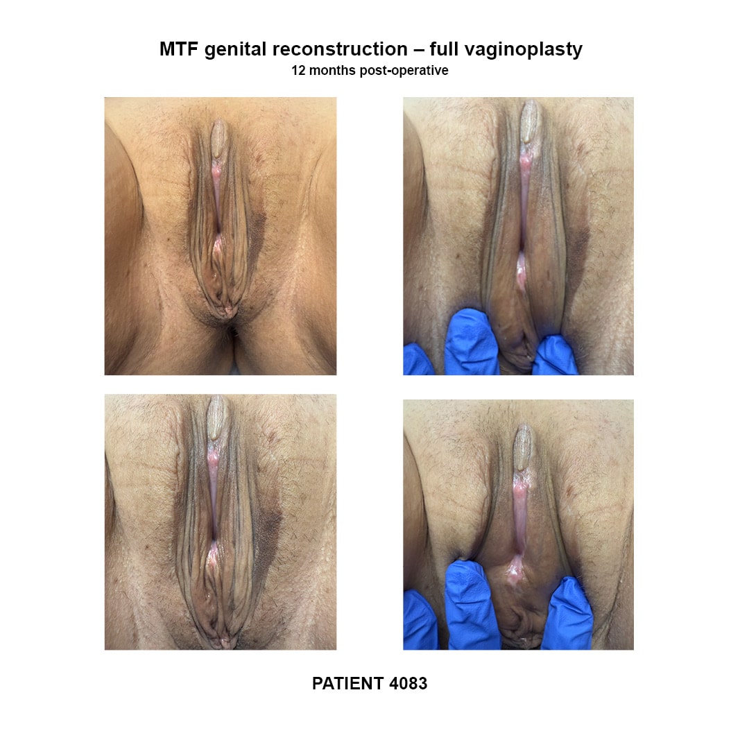 4083_GRS full vaginoplasty
