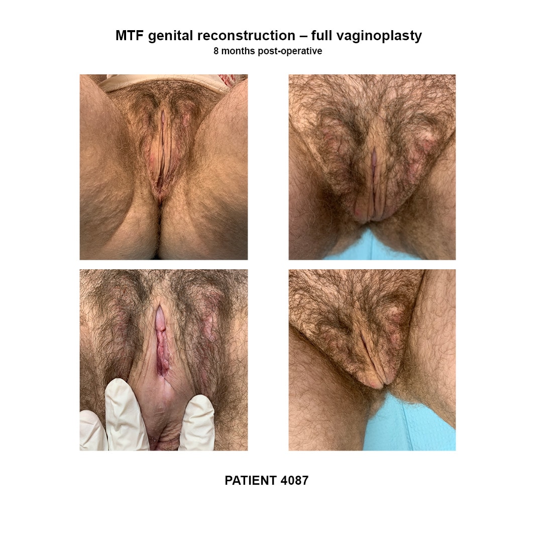 4087_GRS full vaginoplasty