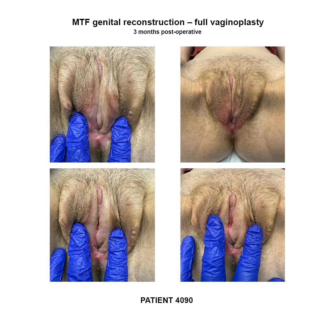 4090_GRS full vaginoplasty